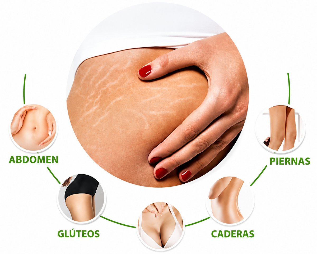 Crema Antiestrías SkinRepair 60 g | Cuidado, Hidratación y Apariencia de la Piel